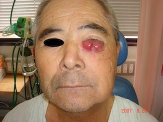 Five months after the first examination, a recurrence of MCC developed in the left lower eyelid