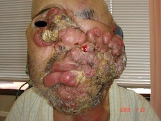 Ten months after the second operation, the recurrent MCC had advanced over almost half of the facial area
