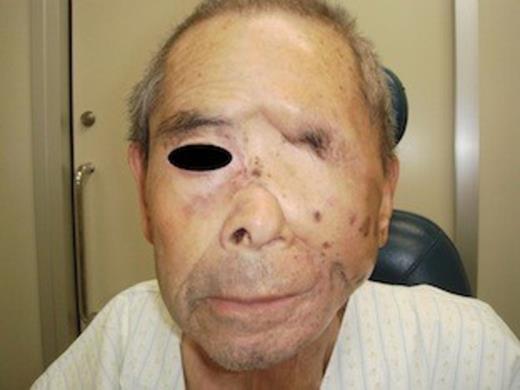 Three months after the beginning of regression, the tumor had completely disappeared