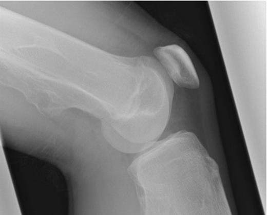 Plain radiographs of the patient’s left knee