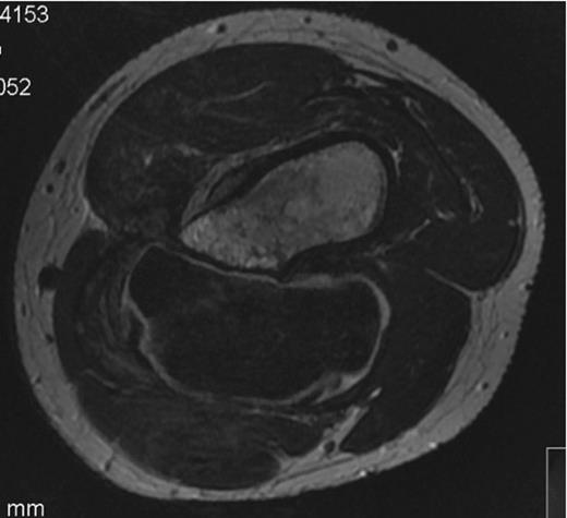 MRI scan of the patient’s left leg