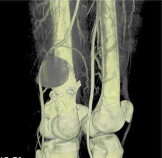 CT angiogram 3D reconstruction- Showing the bony exostoses and the popliteal aneurysm posterior to the right distal femur