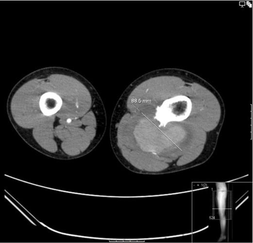 CT angiogram: Showing the diameter size of the aneurysm to be 88.6mm. The cross sectional image clearly shows the sharp bony exostoses that slowly eroded into the popliteal artery resulting in the pseudoaneurysm formation. The image also shows that the defect in the artery is still patent because the pseudoaneurysm is filling with contrast