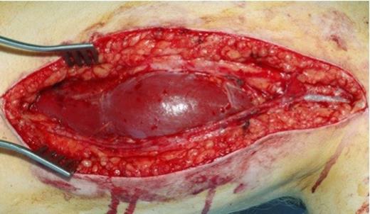 Intraoperative Photograph showing the popliteal aneurysm