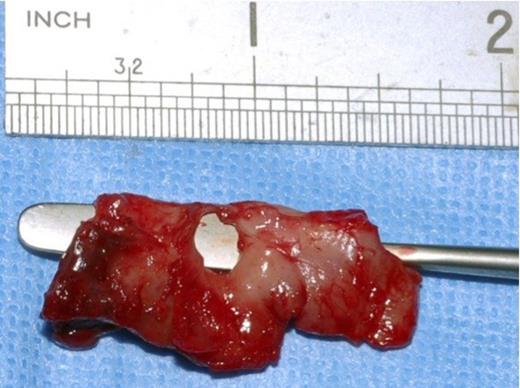 Intraoperative Photograph showing the 1cm x 0.5cm defect in the popliteal artery wall caused by the sharp bony exostoses