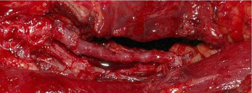 Intraoperative Photograph showing the end to end interpositional long saphenous vein graft