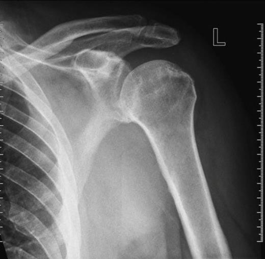 X-ray of left shoulder on presentation