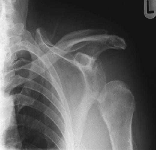 Repeat X-ray of left shoulder demonstrating subluxation of the head of the humerus