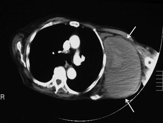 CT angiography of left shoulder demonstrating the pseudoaneurysm