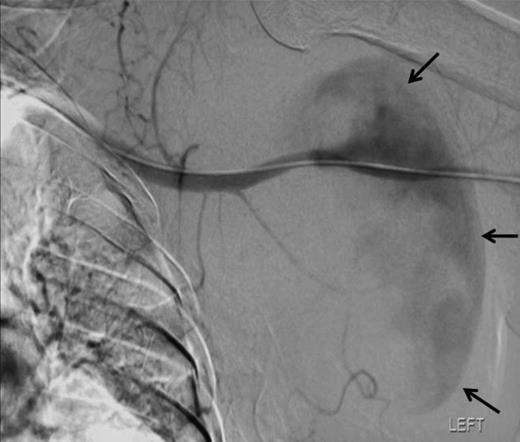 Angiographic localisation of the lesion in the third part of the axillary artery. Please note extravasation of contrast into the sac (arrows)