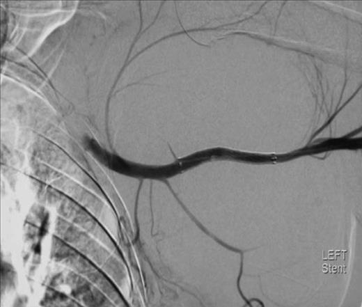 Angiography following stent insertion