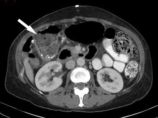 CT image demonstrating low attenuation lesion in the left lobe of the liver with surrounding inflammation consistent with a liver abscess