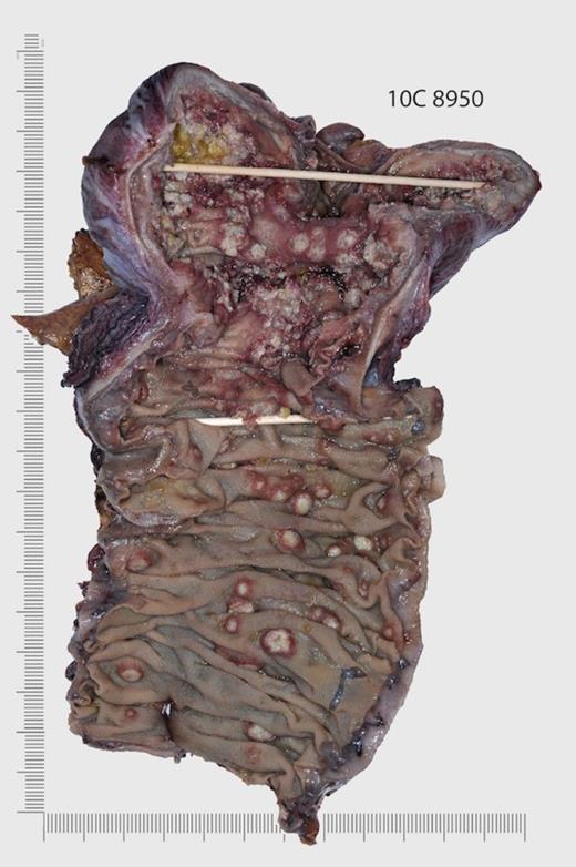 Gross appearance of caecum and ascending colon showing ulcerated and polypoidal amoebic lesions mimicking colonic mucosal tumours