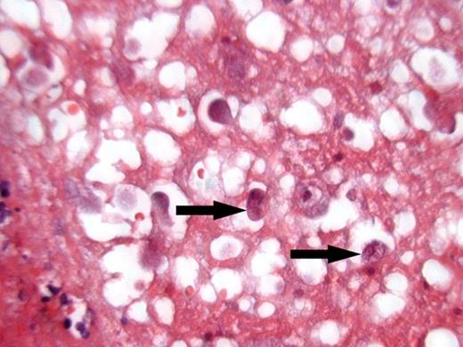 H&E stained histological section of amoebic abscess in the colonic wall demonstrating Entamoeba Histolitica parasites (arrowed).