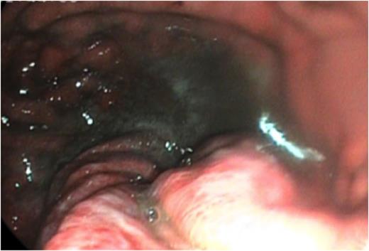 OGD showing a normal calibre proximal stomach, which narrowed sharply at the mid-body.