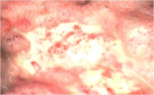 OGD showing multiple punctate mucosal lesions