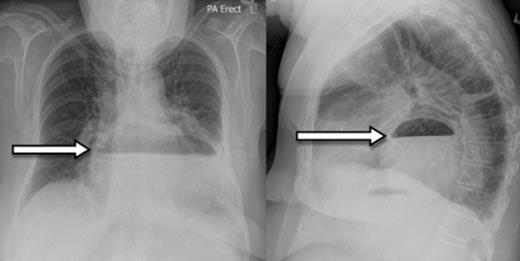 Chest X-ray showing paraoesophageal hernia with retro-cardiac air-fluid level (arrow)