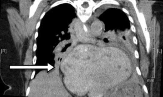 CT showing a large strangulated paraoesophageal hernia (arrow) within the thoracic cavity