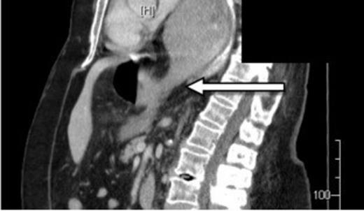 CT showing gas within stomach wall (arrow) suggestive of gastric necrosis