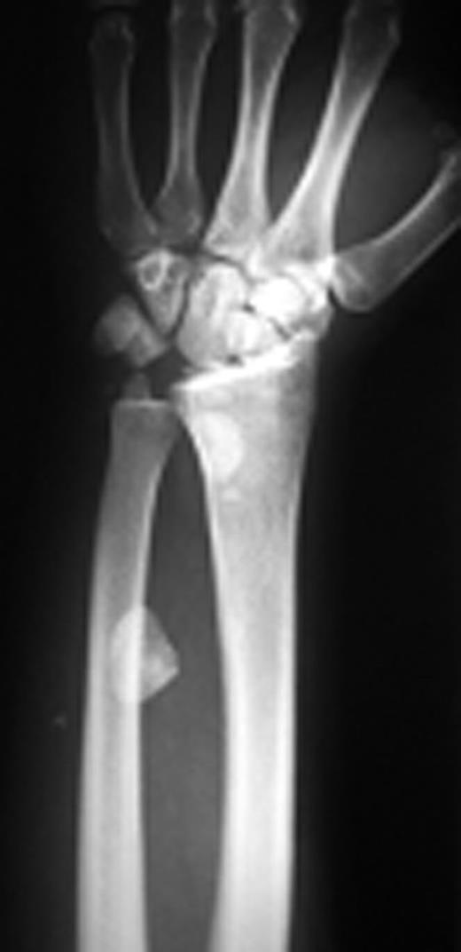 Posteroanterior and lateral X-rays of left wrist show perilunate fracture dislocation with excessive proximal displacement of lunate and proximal scaphoid. Loss of carpal height with broken Gilula’s arcs is obvious.