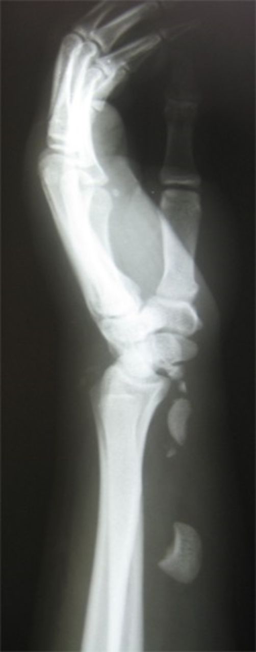 Posteroanterior and lateral X-rays of left wrist show perilunate fracture dislocation with excessive proximal displacement of lunate and proximal scaphoid. Loss of carpal height with broken Gilula’s arcs is obvious.