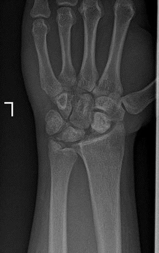 Posteroanterior and lateral radiographs of left wrist two years after operation show increased density of lunate and proximal scaphoid with subtle arthritic changes. Scapholunate dissociation (Terry-Thomas sign) and dorsal intercalated segment instability are seen.
