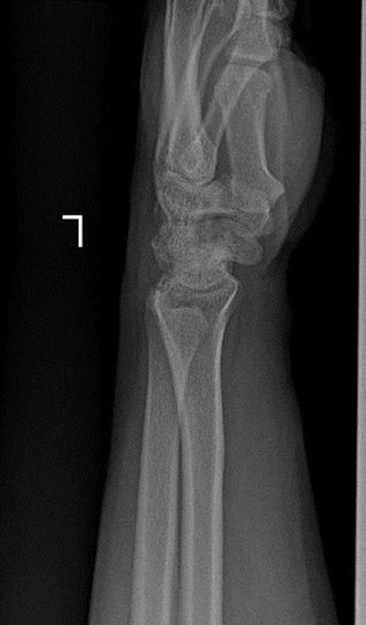 Posteroanterior and lateral radiographs of left wrist two years after operation show increased density of lunate and proximal scaphoid with subtle arthritic changes. Scapholunate dissociation (Terry-Thomas sign) and dorsal intercalated segment instability are seen.