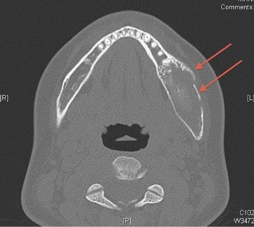 Pre-operative image of the patient showing facial asymmetry