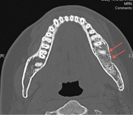 Pre-operative axial CT showing the lesion in the left side of the mandible (denoted by arrows).