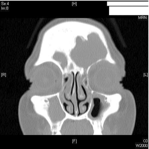 CT Scan – coronal view showing a left sided mucocele.