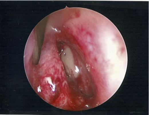 Patent ostia visualised endoscopically post dilatation with free drainage of mucopus.