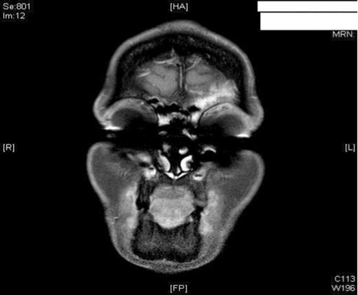 MRI imaging (a) coronal (b) axial views post procedure revealing resolution of the mucocele and no intracranial or orbital complications (see figure 1).