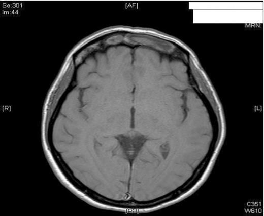 MRI imaging (a) coronal (b) axial views post procedure revealing resolution of the mucocele and no intracranial or orbital complications (see figure 1).