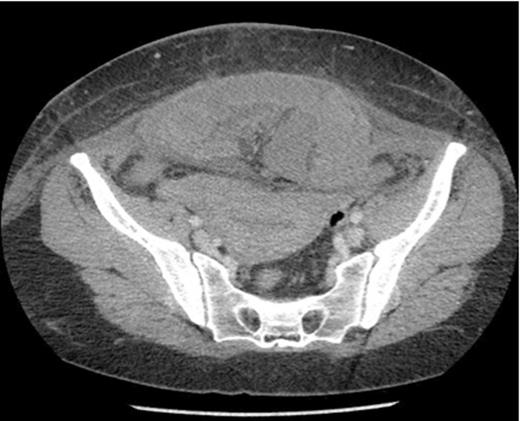 Axial section showing dilated loops of small bowel and a segment of small bowel adherent to the anterior abdominal wall.