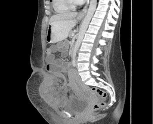 Sagittal section showing dilated loops of small bowel and a segment of small bowel adherent to the anterior abdominal wall.