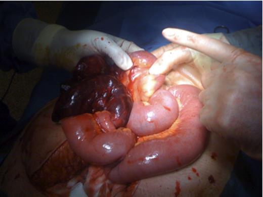 Operation pictures showing necrotic small bowel loop and dilated proximal small bowel.