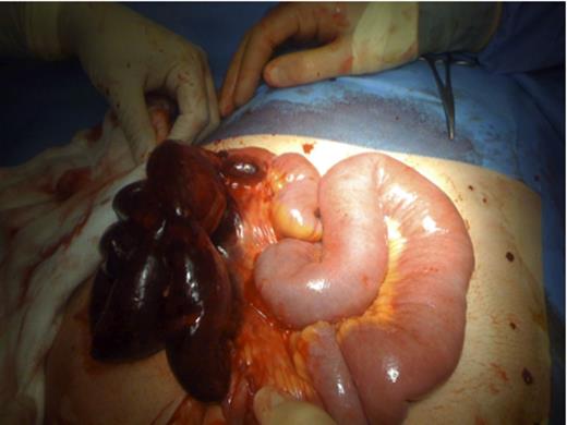 Operation pictures showing necrotic small bowel loop and dilated proximal small bowel.
