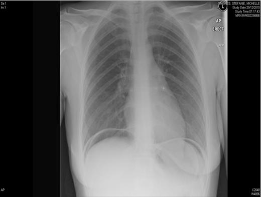 Erect chest X-ray highlighting the presence of subphrenic gas
