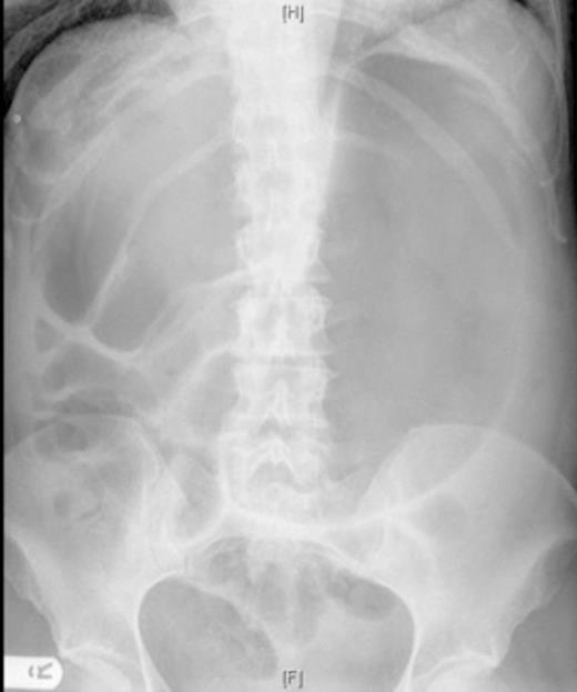 AP abdominal radiograph; markedly distended stomach and distension of bowel loops in the right upper quadrant