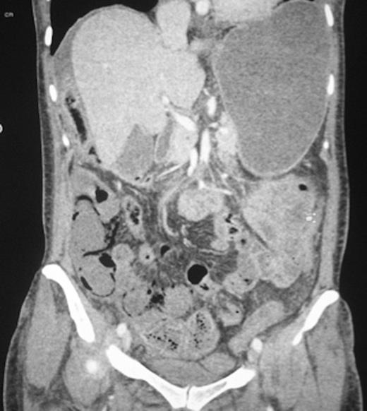 Occluded superior mesenteric artery