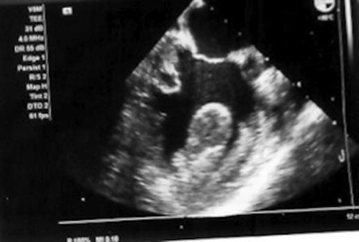 echocardiogram showing intracardiac tumour