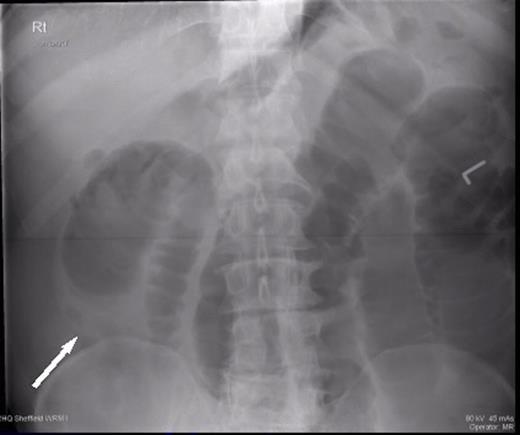 Plain radiograph showing dilated small loops of bowel with a transition point in the right upper quadrant