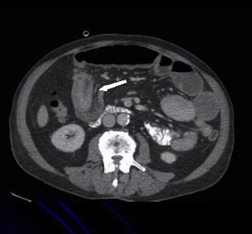 Axial CT showing ileo-ileal intussusception