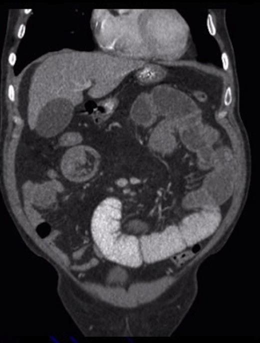 Coronal CT showing the ‘donut’ appearance of the intussusception