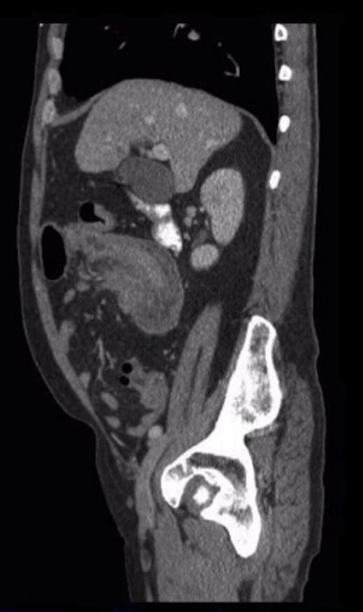 Sagittal CT showing the ‘sausage’ appearance of the intussusception