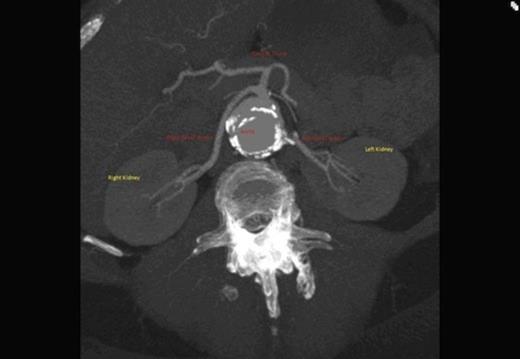 Origin of the right renal artery