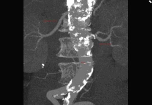 Origin of the right renal artery