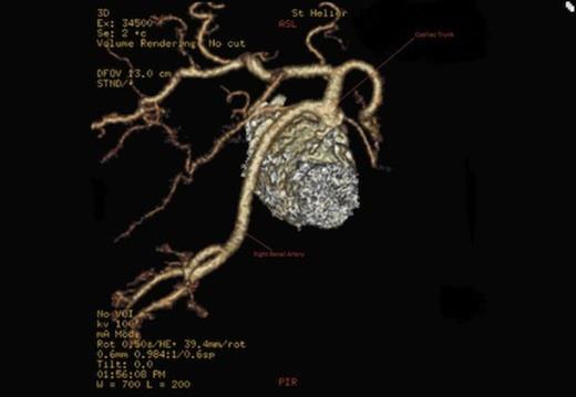 Origin of the right renal artery