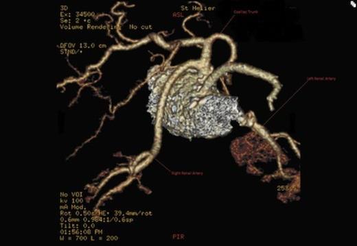 Origin of the right renal artery