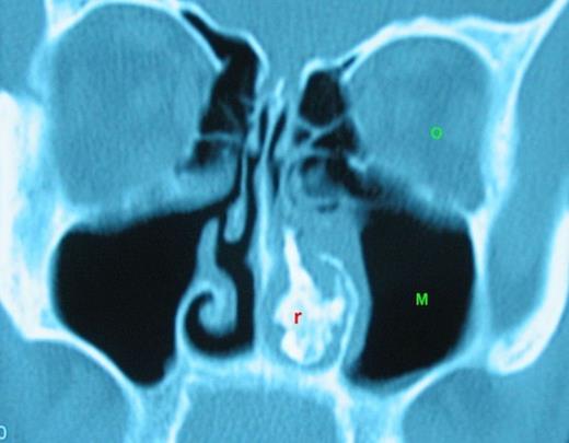 Rinolith is seen on the left nasal cavity. (r: rinolith, O: orbit, M: Maxillary sinus)
